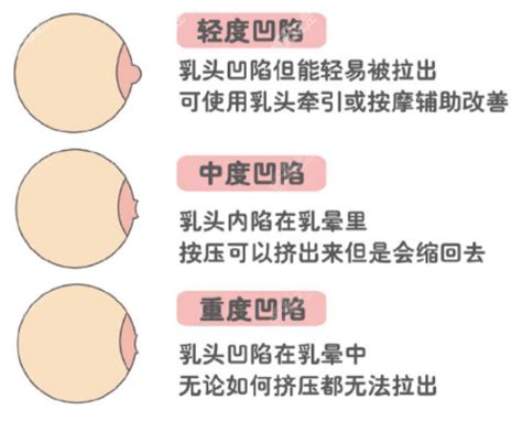 乳頭 長毛|乳頭內凹、長毛正常嗎？ 8類「乳頭形狀」你的是哪種 